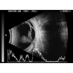 Ophthalmology AB Ultrasonic Scanner ODM-2100